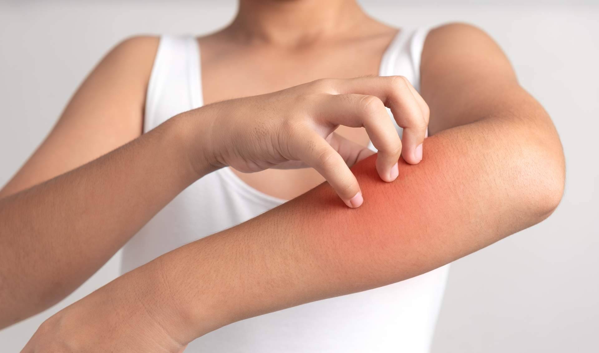 Laboratorio Géomer lanza un tratamiento natural psoriasis corporal sin cortisona