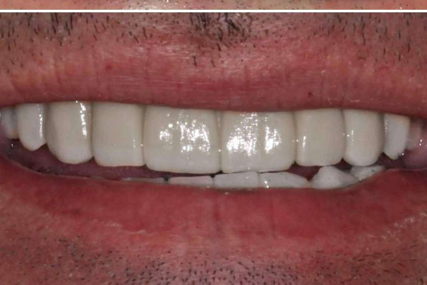 Implant Clinics resalta los beneficios de su tratamiento ALL ON 4