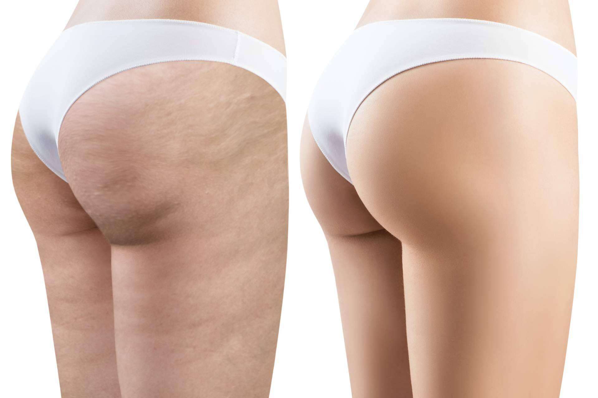 Combatir la celulitis es posible gracias a los tratamientos con envolturas de algas reductoras de Crina Rus Beauty Center