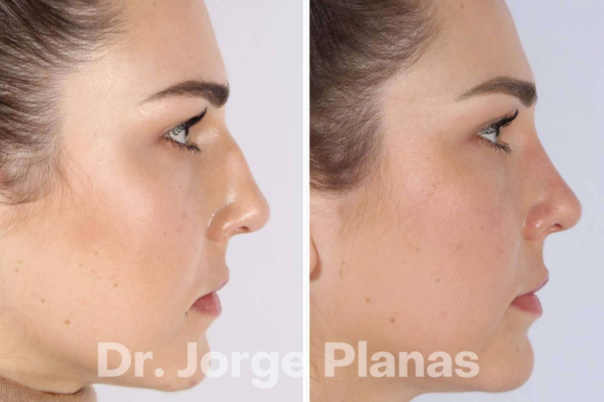 Rinoplastia ultrasónica de la mano del Dr. Jorge Planas