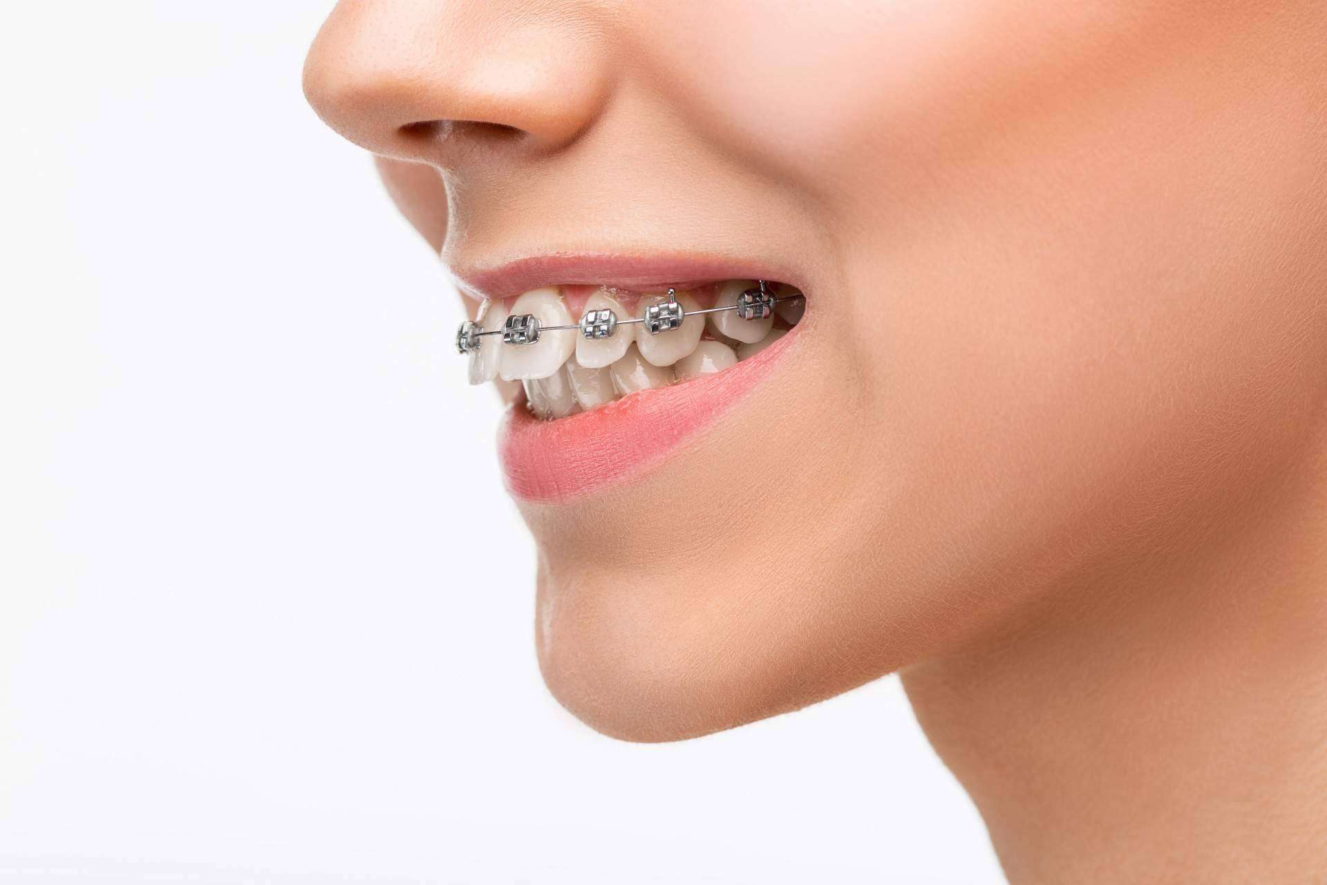 Ortodoncia infantil en Córdoba de la mano de Corporación Dental, corregir a tiempo garantiza una óptima salud bucal