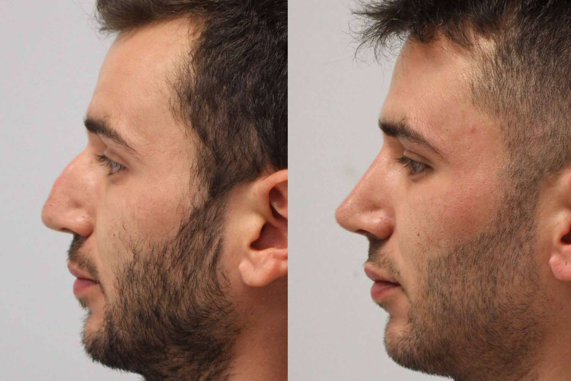 Un avance médico que está disponible en Valladolid y Santander, la rinoplastia ultrasónica