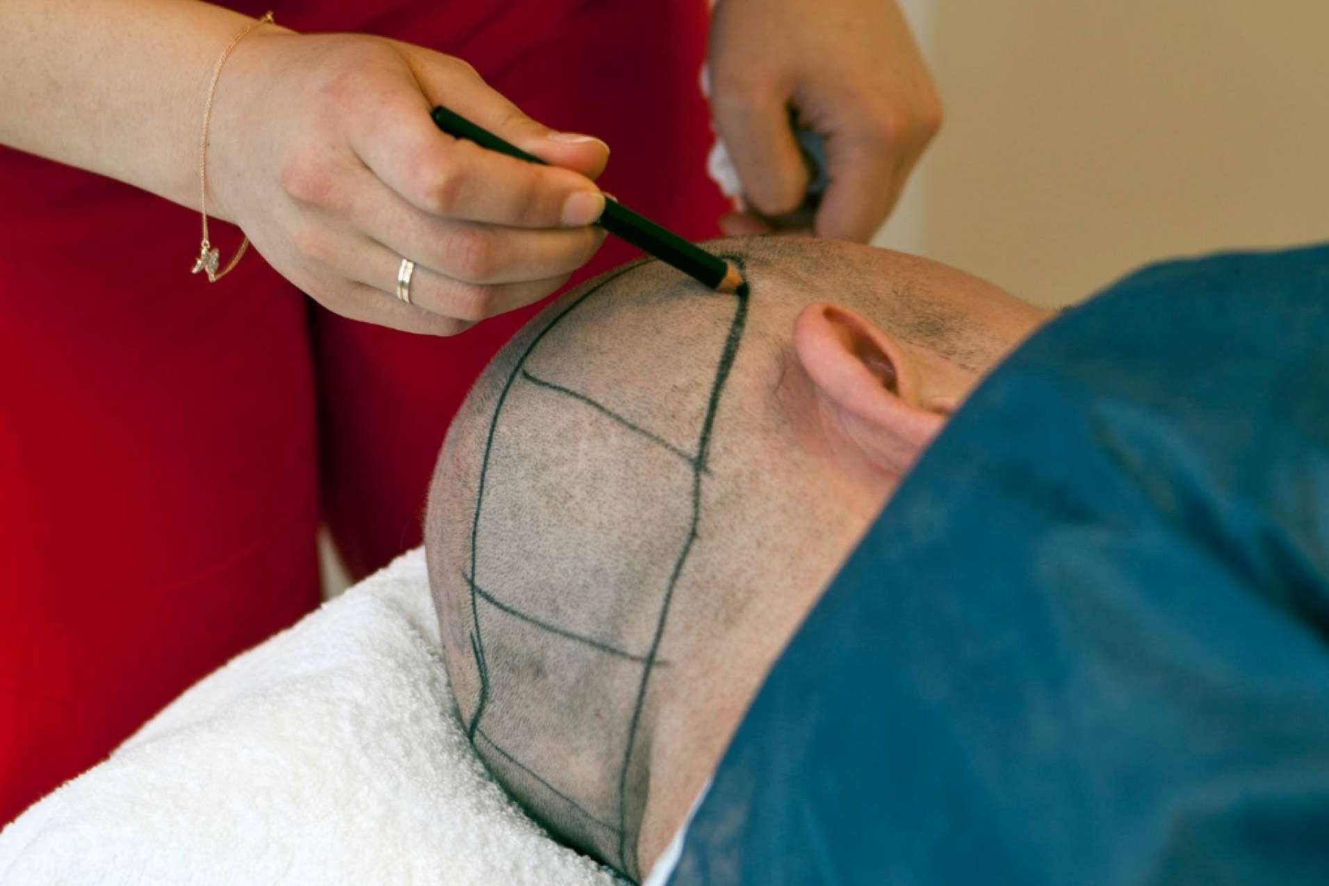 El Dr. Antonio Fernández Brito lleva a cabo el microinjerto capilar en Madrid en Microcapilar Hair Clinic