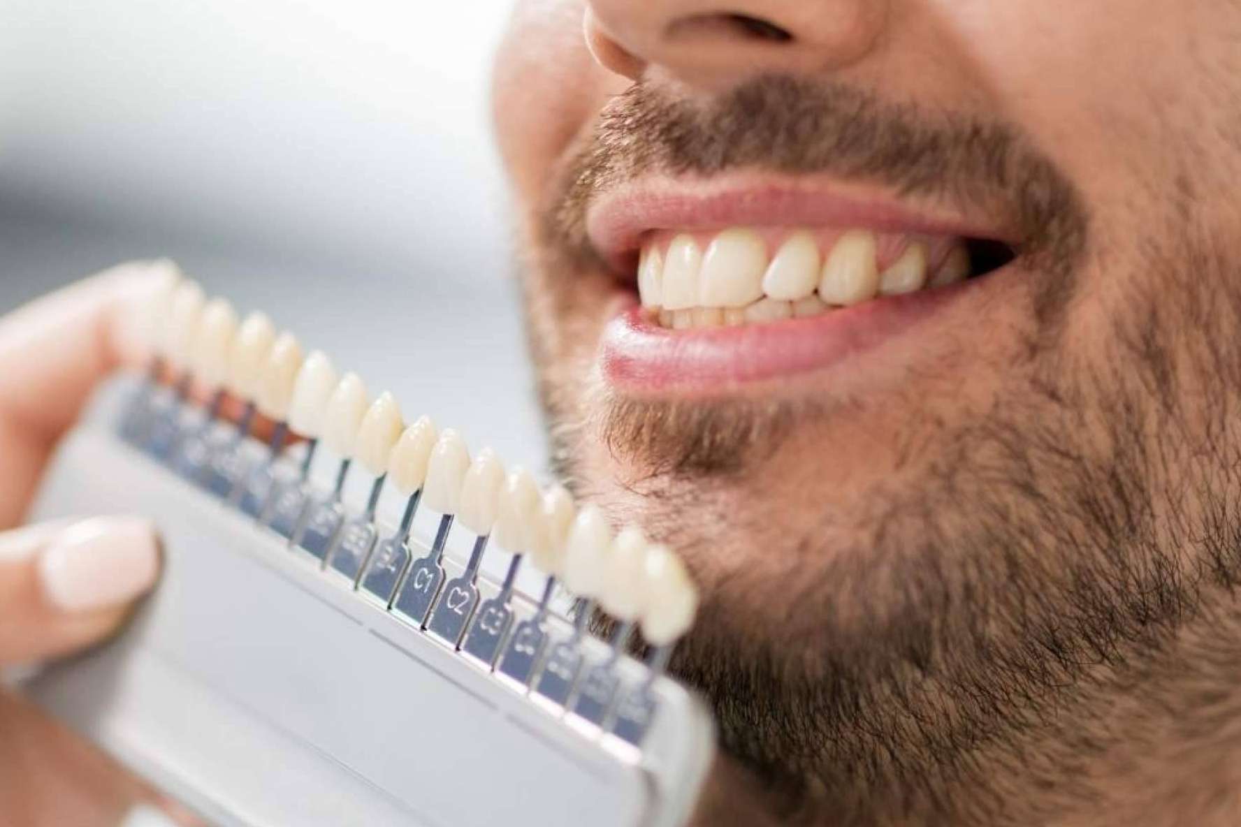 Carillas dentales, la forma de recuperar la estética de la sonrisa en un día