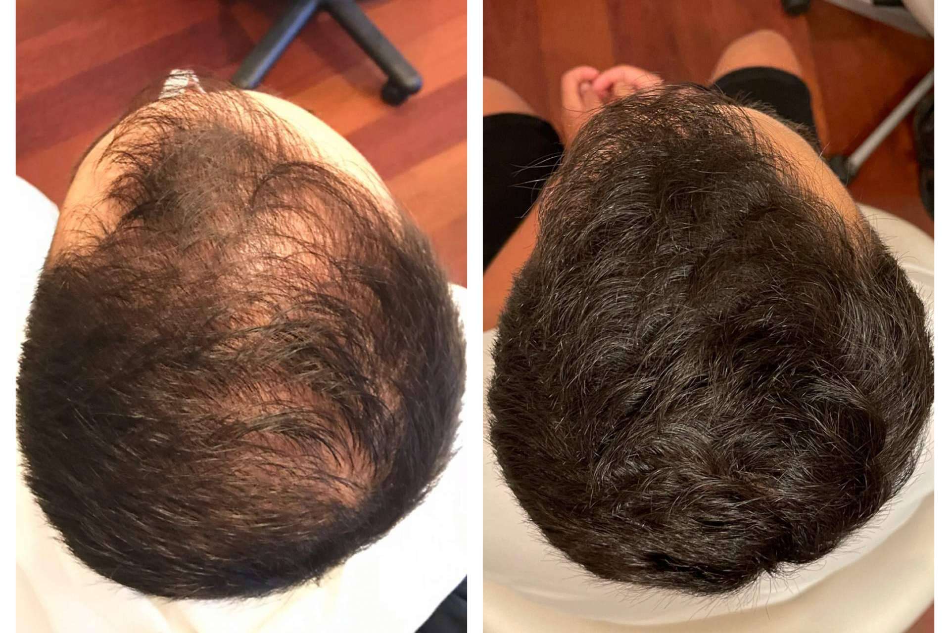 La clínica dermatológica De Felipe realiza infiltraciones dutasteride para tratar la alopecia