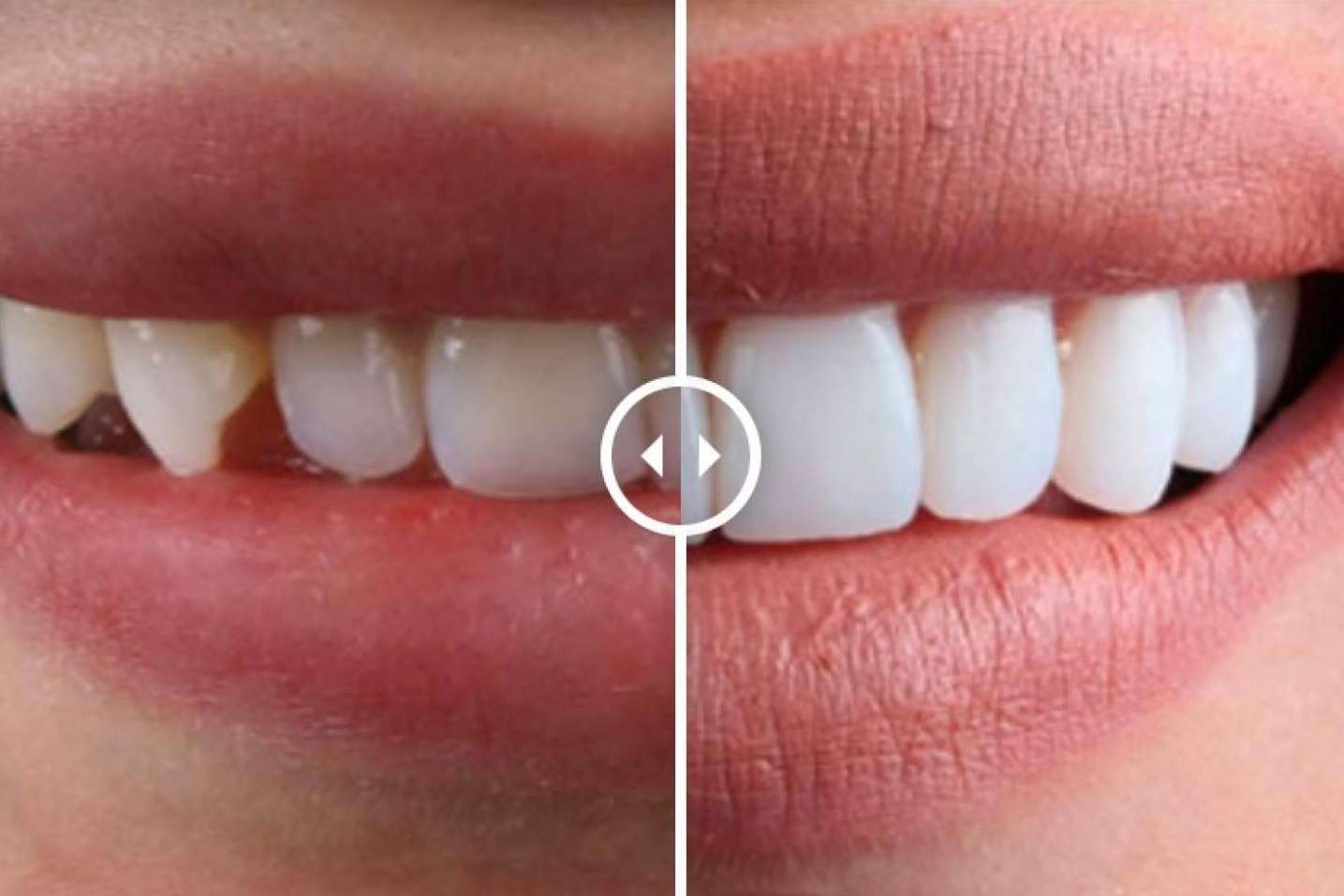 Todo acerca de las carillas dentales, por Crespí & Gandía