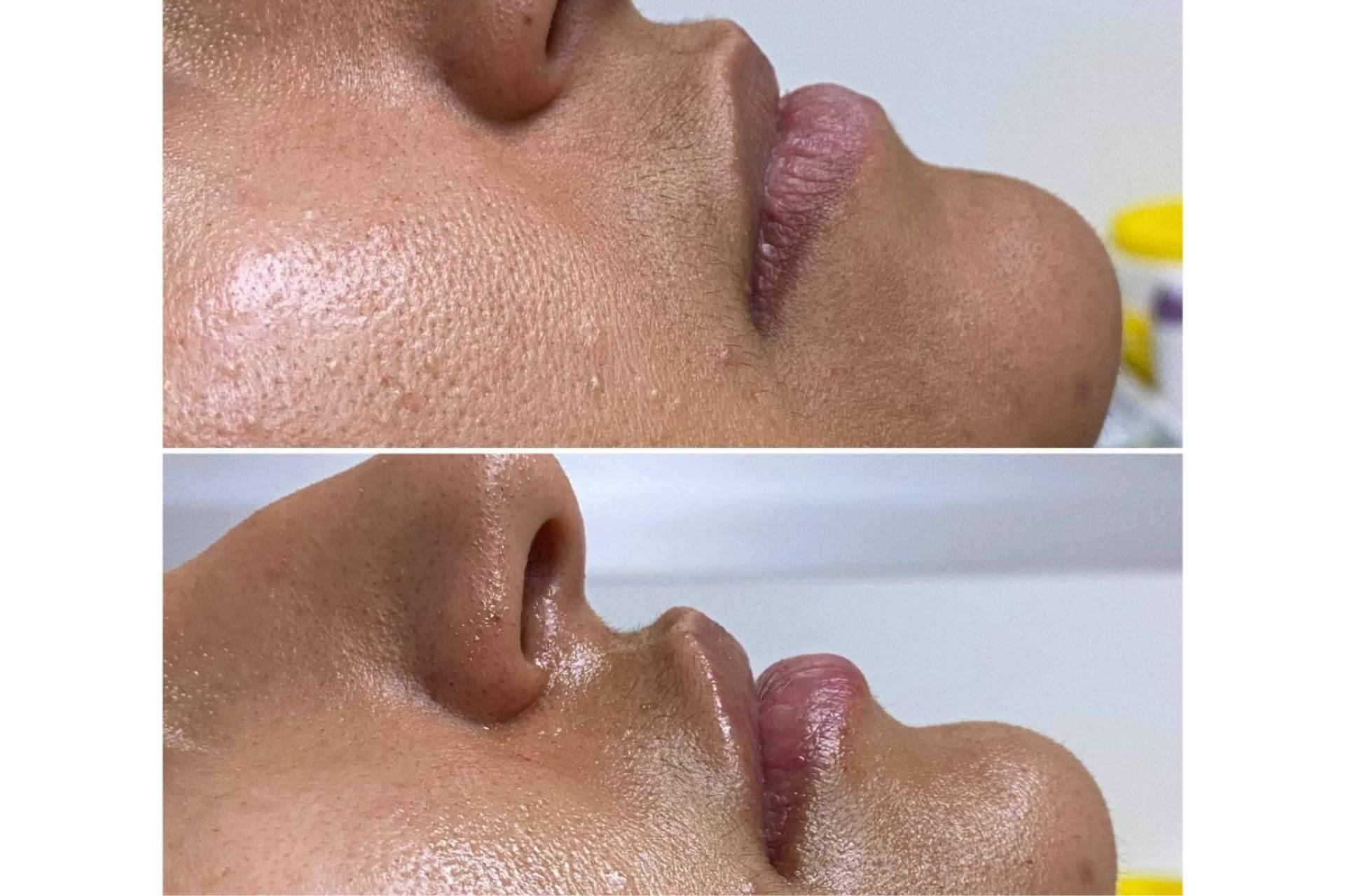 El tratamiento de aumento de labios que realiza la Clínica Yasmin
