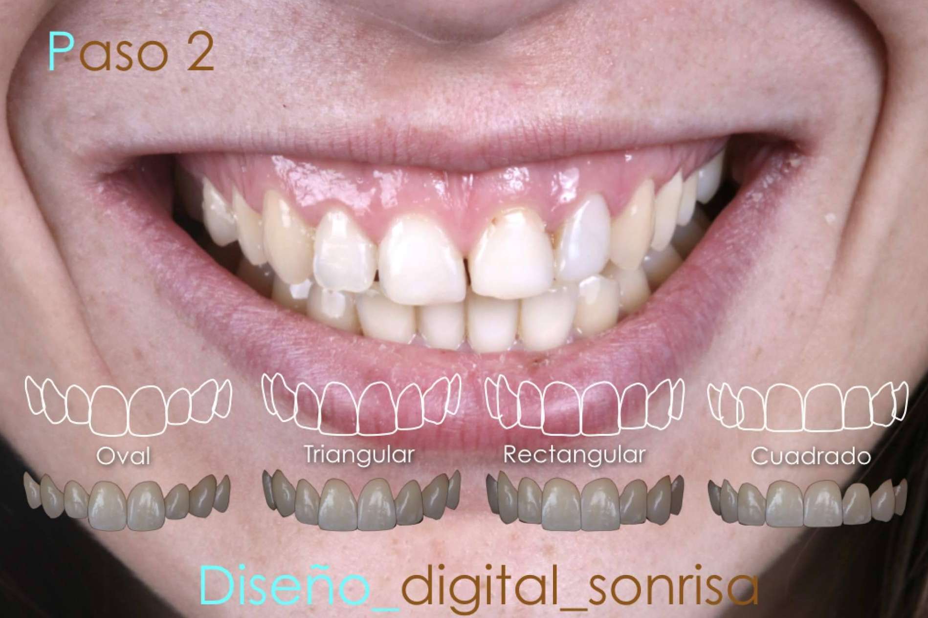 Las ventajas de realizarse un diseño de sonrisa en la Clínica Dental Ruiz de Gopegui