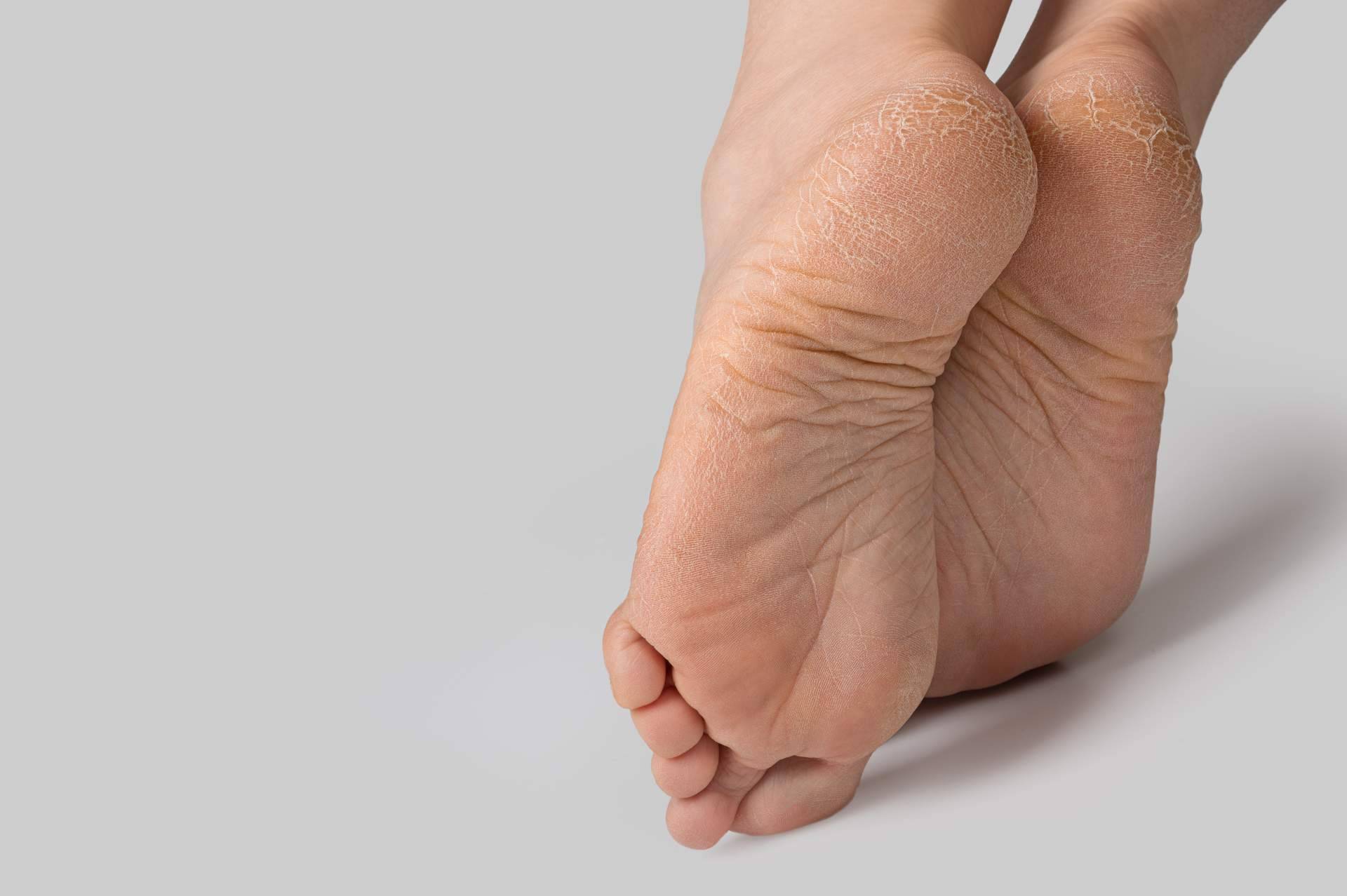 La importancia de utilizar plantillas a medida para las diversas dolencias en el pie, Clínica de Podología Integral Pododerm