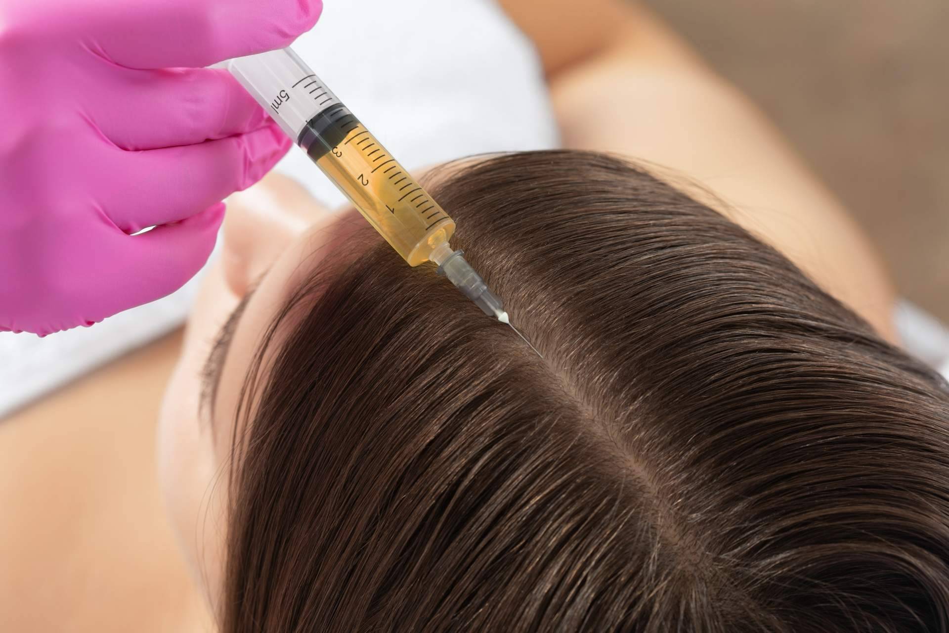 Recuperar la densidad capilar perdida mediante los tratamientos especializados para la alopecia difusa de MC360
