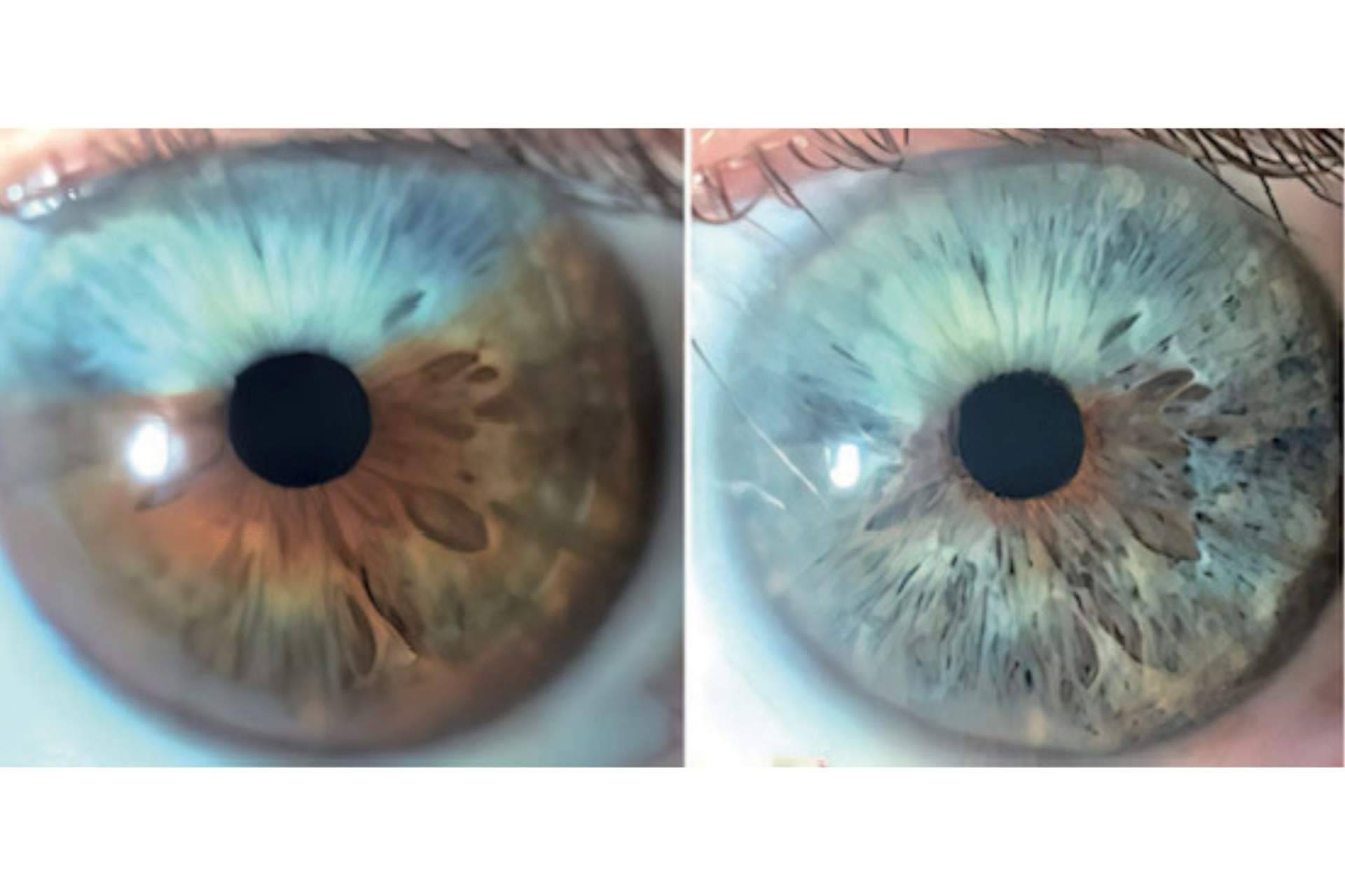 Clínica Eyecos afirma que los heterocromías y los nevus del iris pueden ser tratados con láser