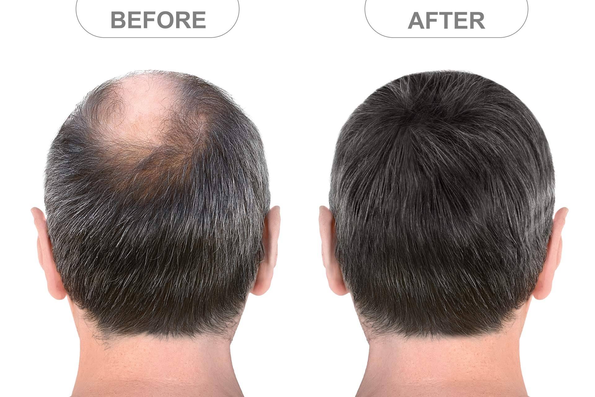 Microinjerto capilar FUE, solución definitiva y mínimamente invasiva para quienes sufren alopecia androgénica