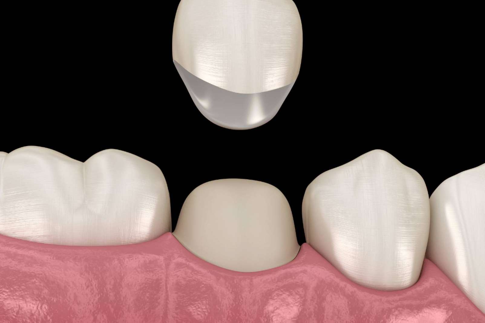 Recuperar la sonrisa perfecta con ayuda de coronas dentales, la solución estética y duradera que ofrece la Clínica Dental Ruiz de Gopegui
