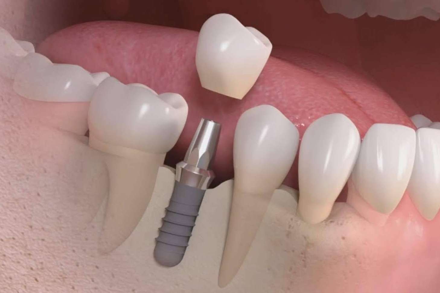 Clínica Calvo de Mora acerca de los implantes dentales que lleva a cabo