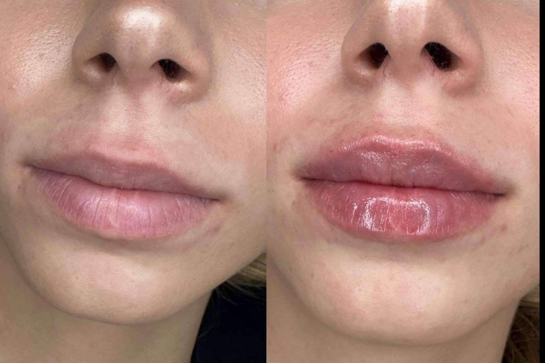La técnica en dos pasos de la doctora Sandra Hermida para unos labios 100 % naturales