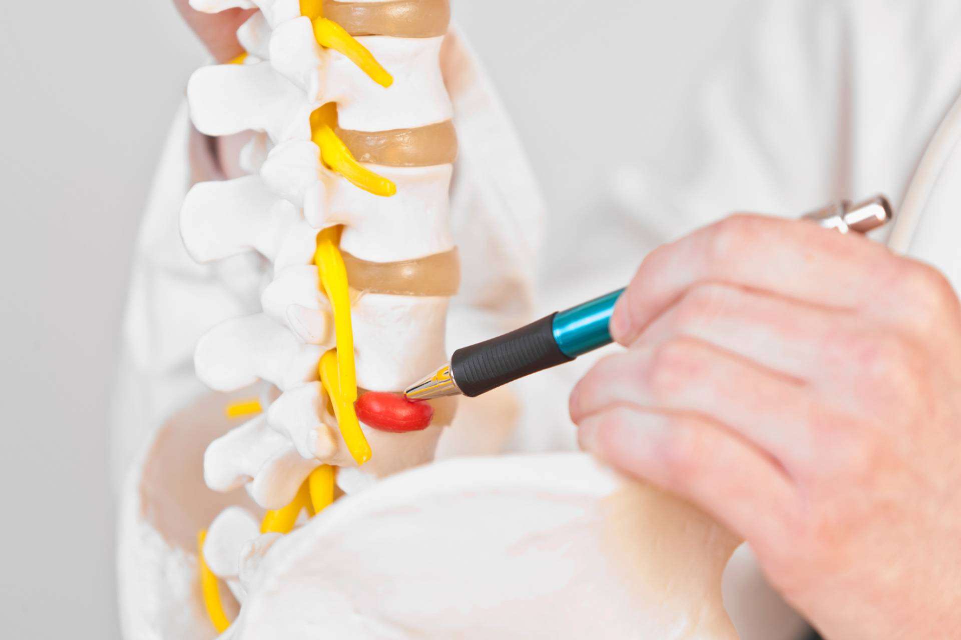 La andulación, un enfoque terapéutico innovador para casos de hernia discal