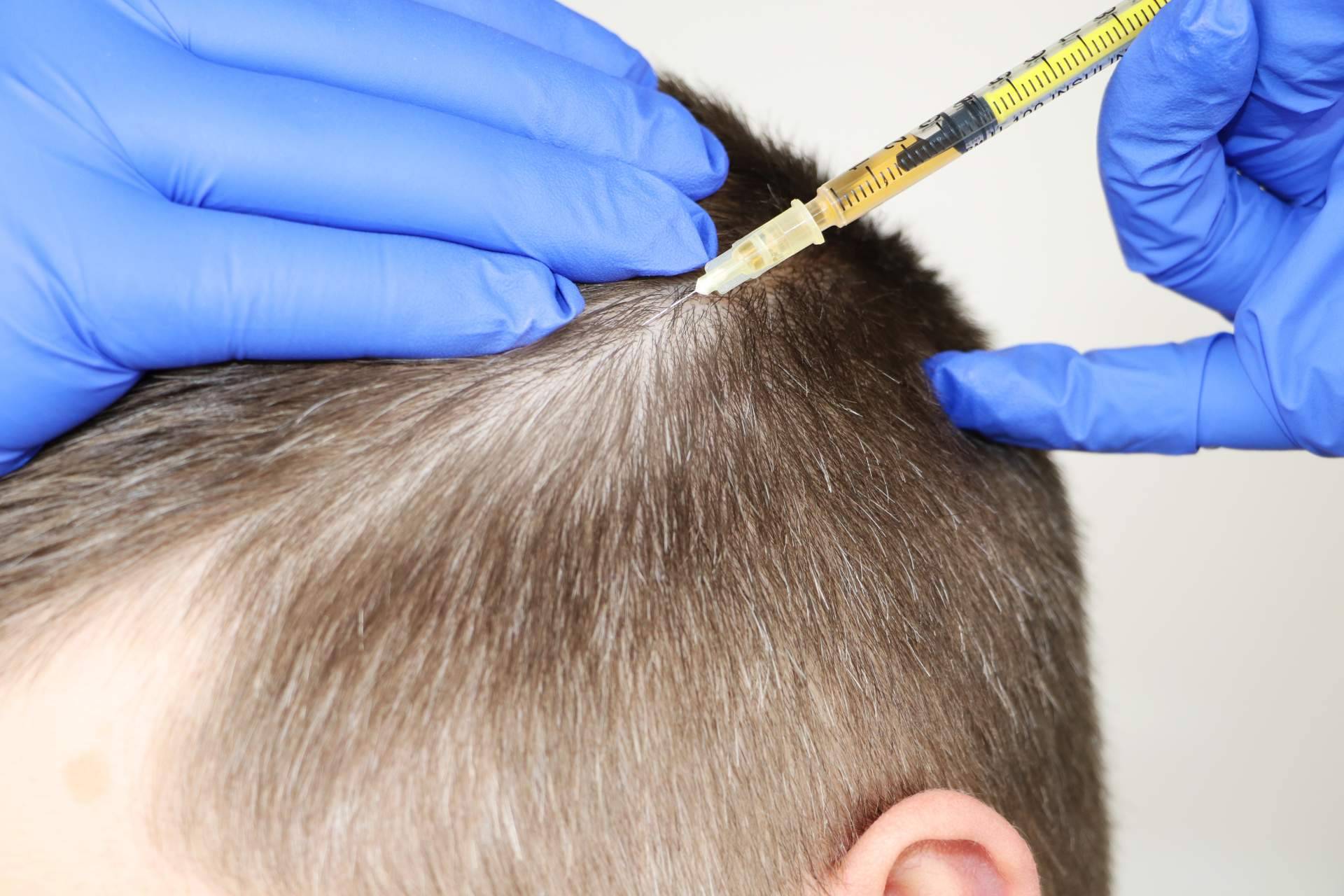 Los tratamientos de mesoterapia, una alternativa muy recomendada para las personas que sufren alopecia según el doctor Jesus Mora