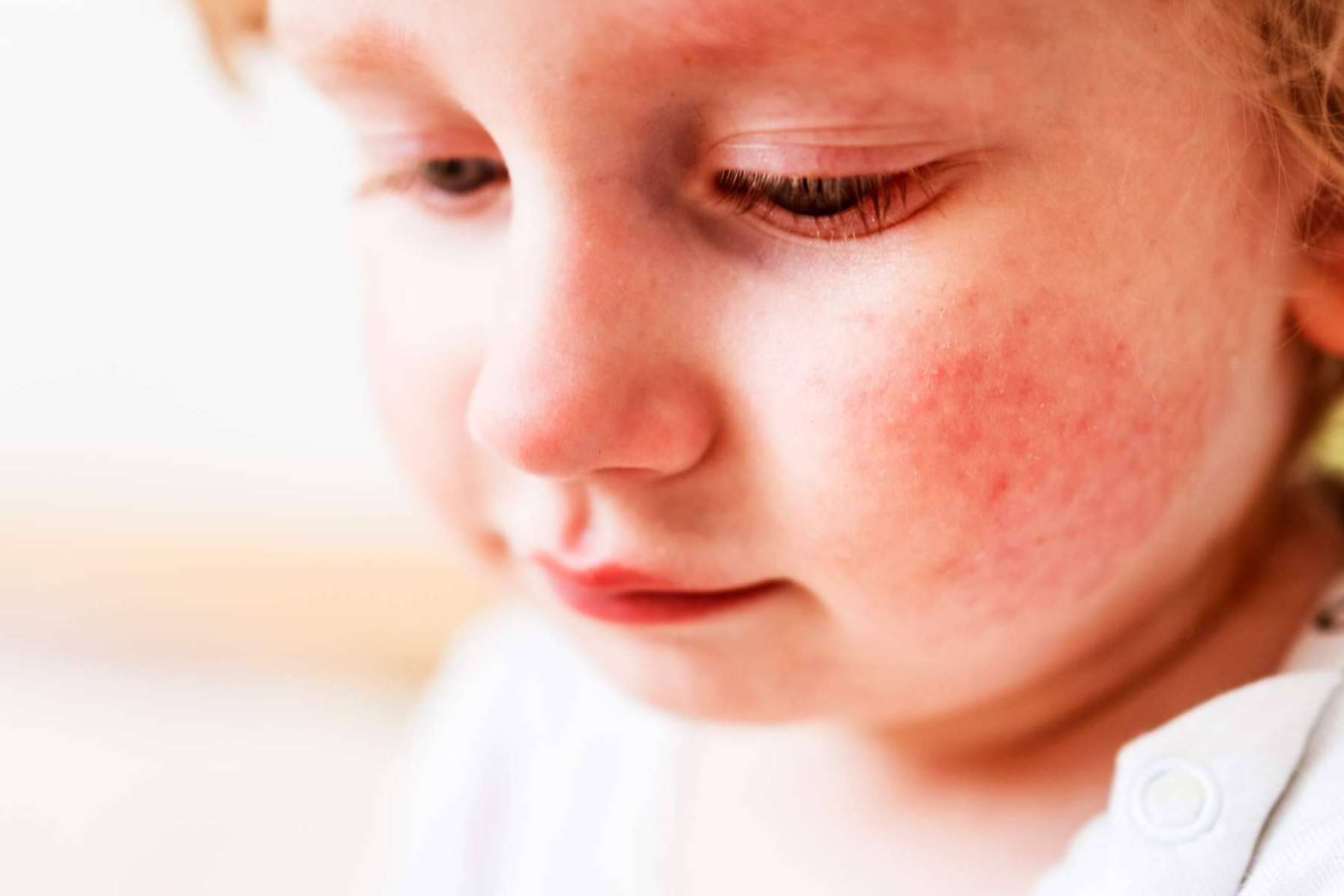 Los luchadores contra el eczema ahora tienen un superhéroe, Novopiel