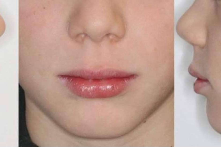 Qué es el mentón Fuyant y cómo tratarlo, por Clínica Zahara
