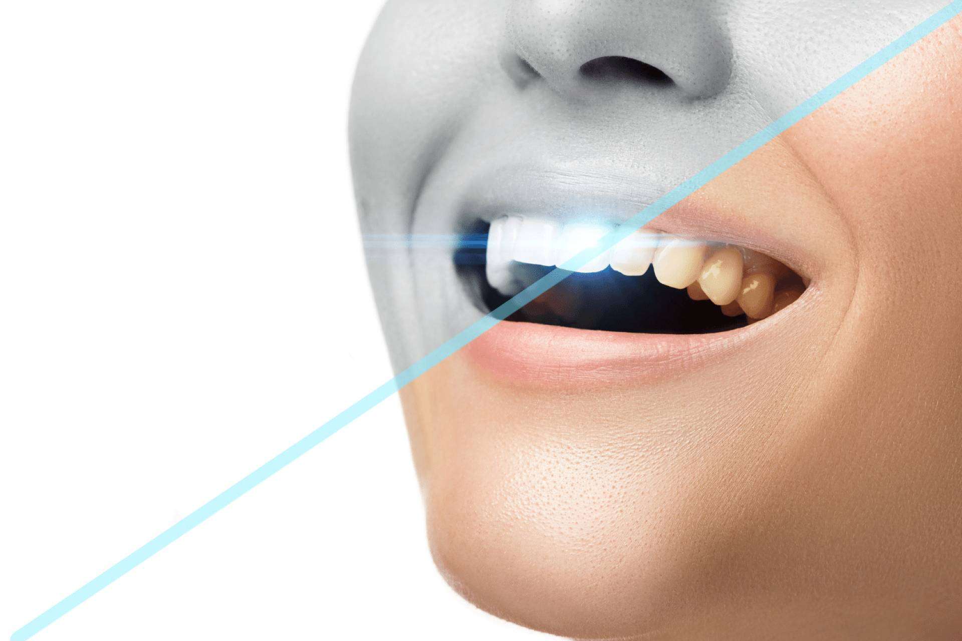 Una opción innovadora para la salud bucal es la ozonoterapia en odontología