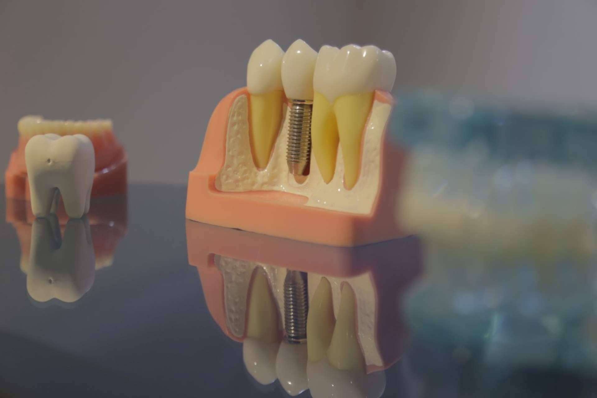 Los implantes dentales de Mexicali, una alternativa buena y más económica que en Estados Unidos