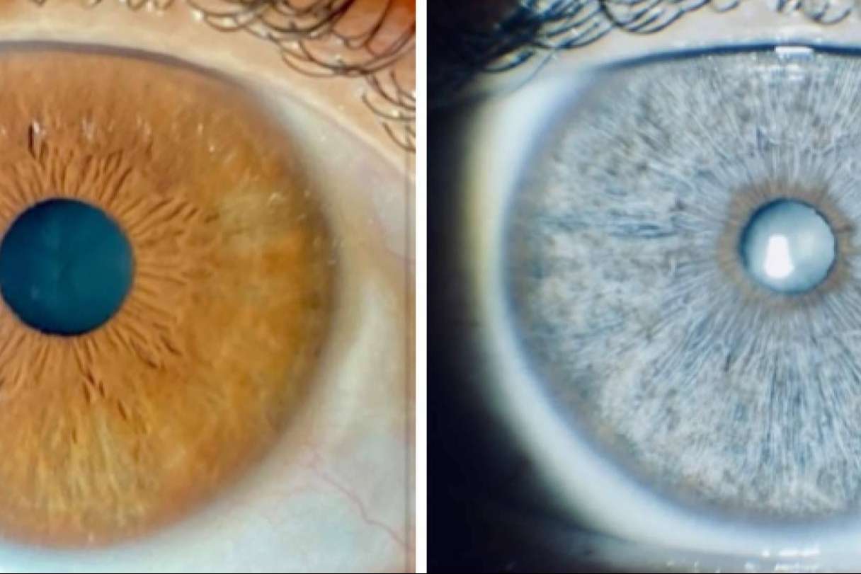 Clínica Eyecos avisa de que los sueros crece pestañas pueden oscurecer los ojos de forma permanente