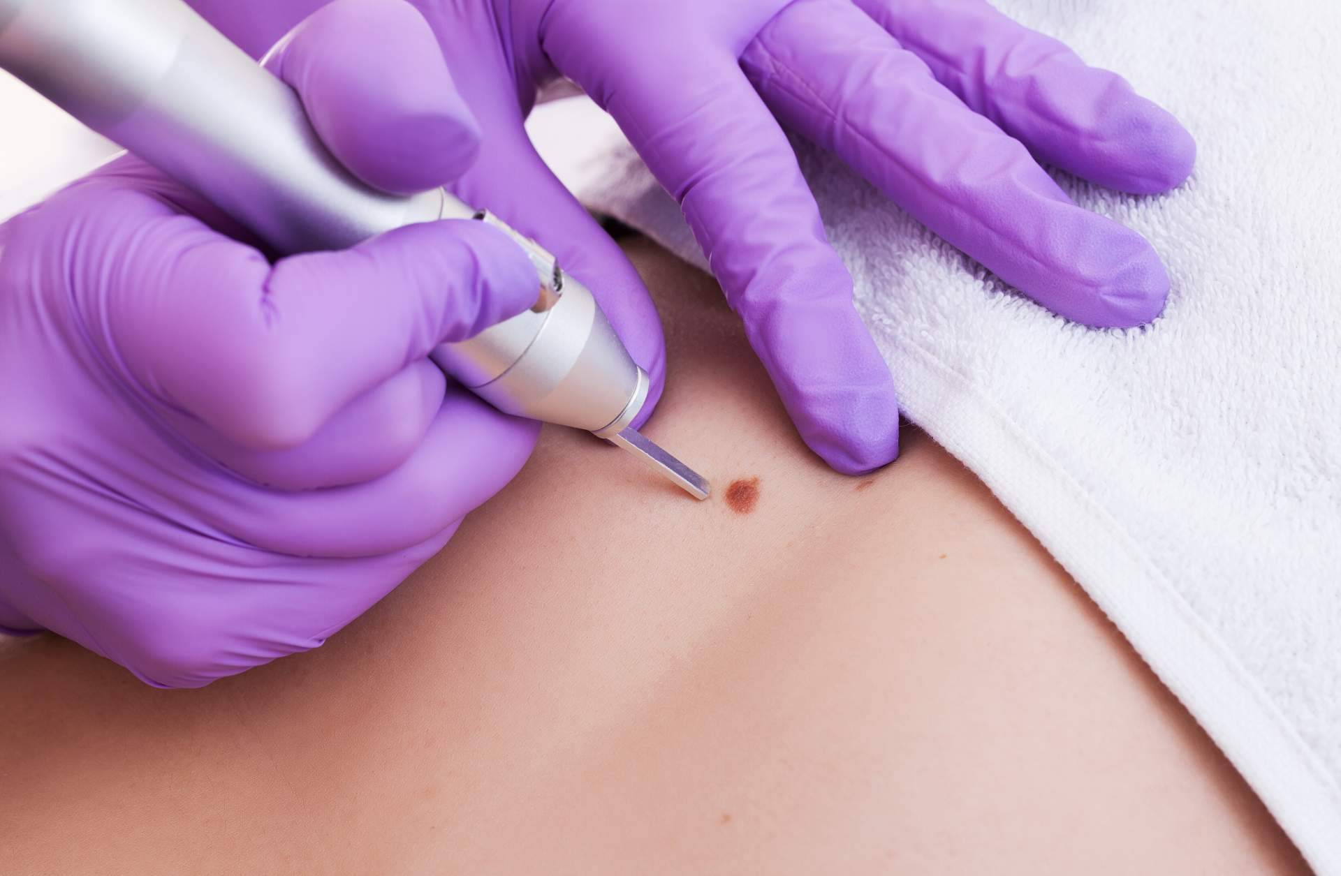 Los servicios de Centro Estética El Pilar permiten eliminar manchas en la piel con láser