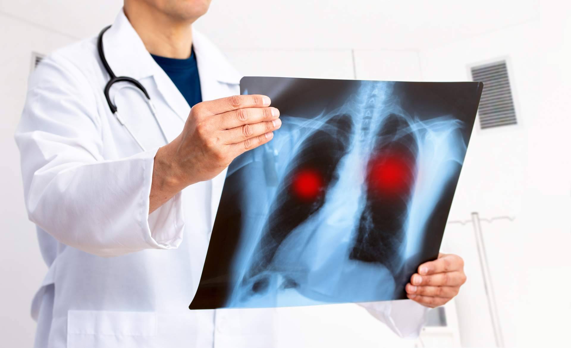 Oncothermia (Nanothermia), el tratamiento de cáncer de pulmón