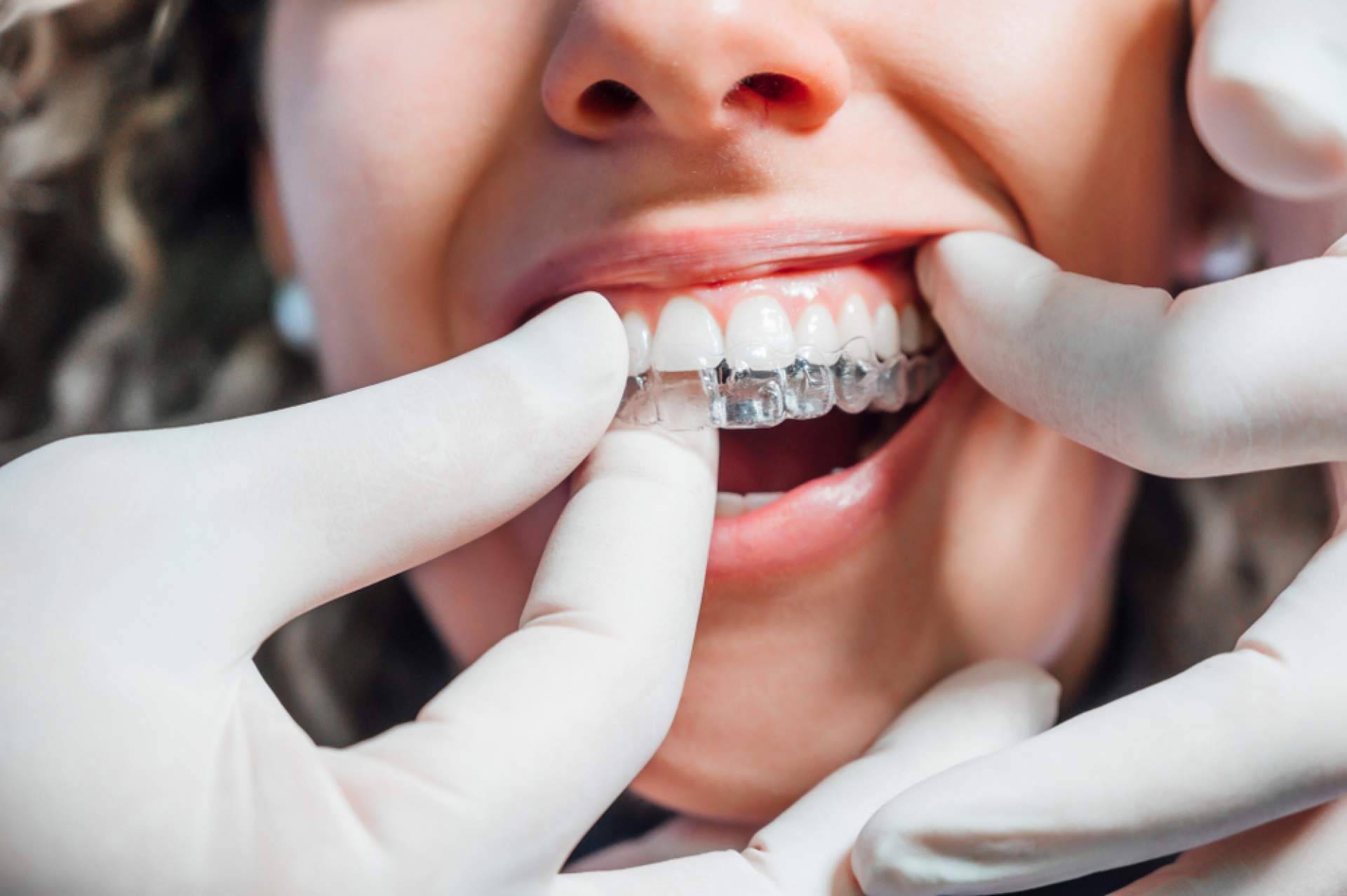 InterORALIA explica los beneficios de la ortodoncia Invisalign