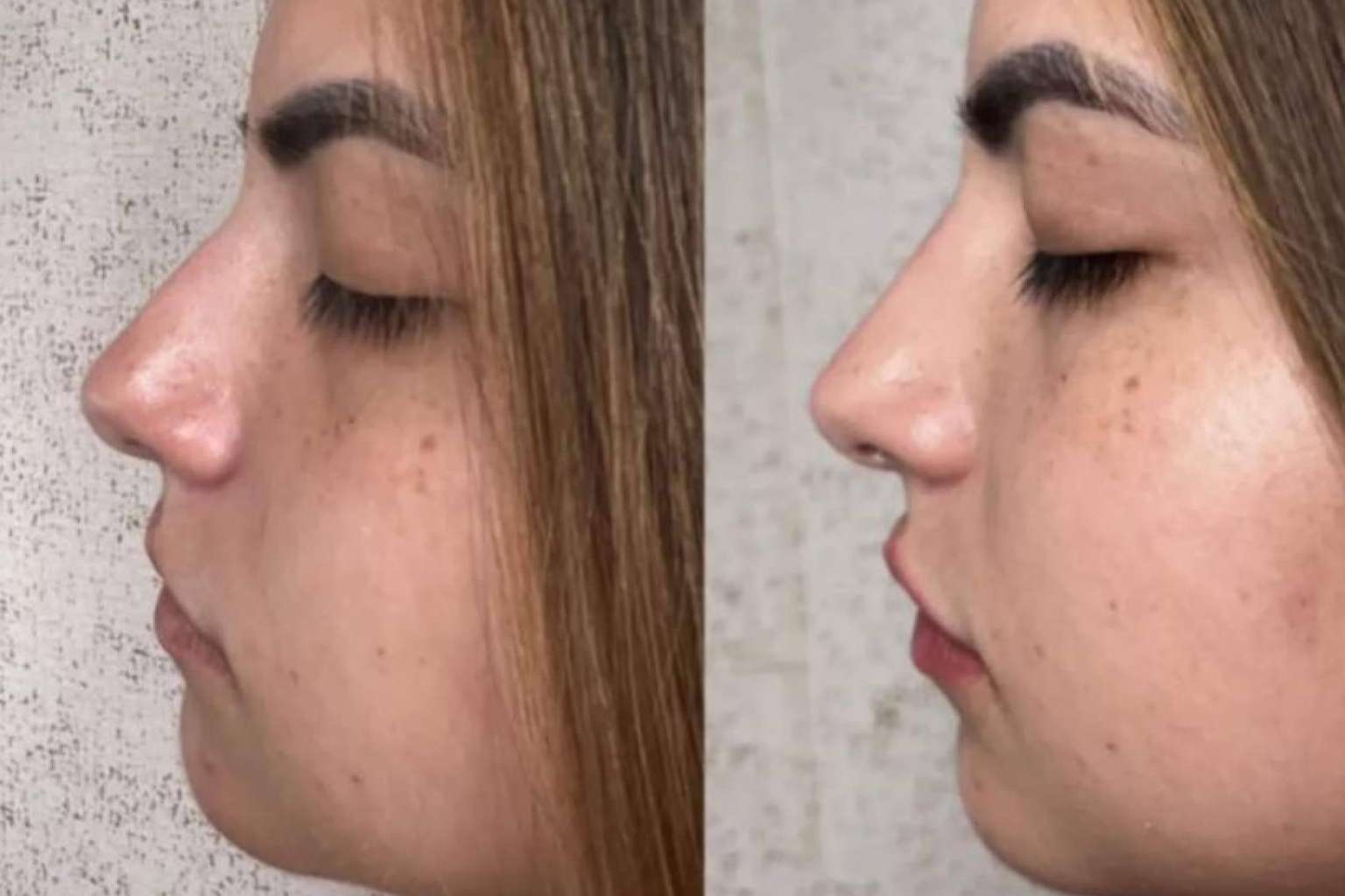 La clínica del Dr. Guidi cuenta con expertos en rinomodelación en Málaga