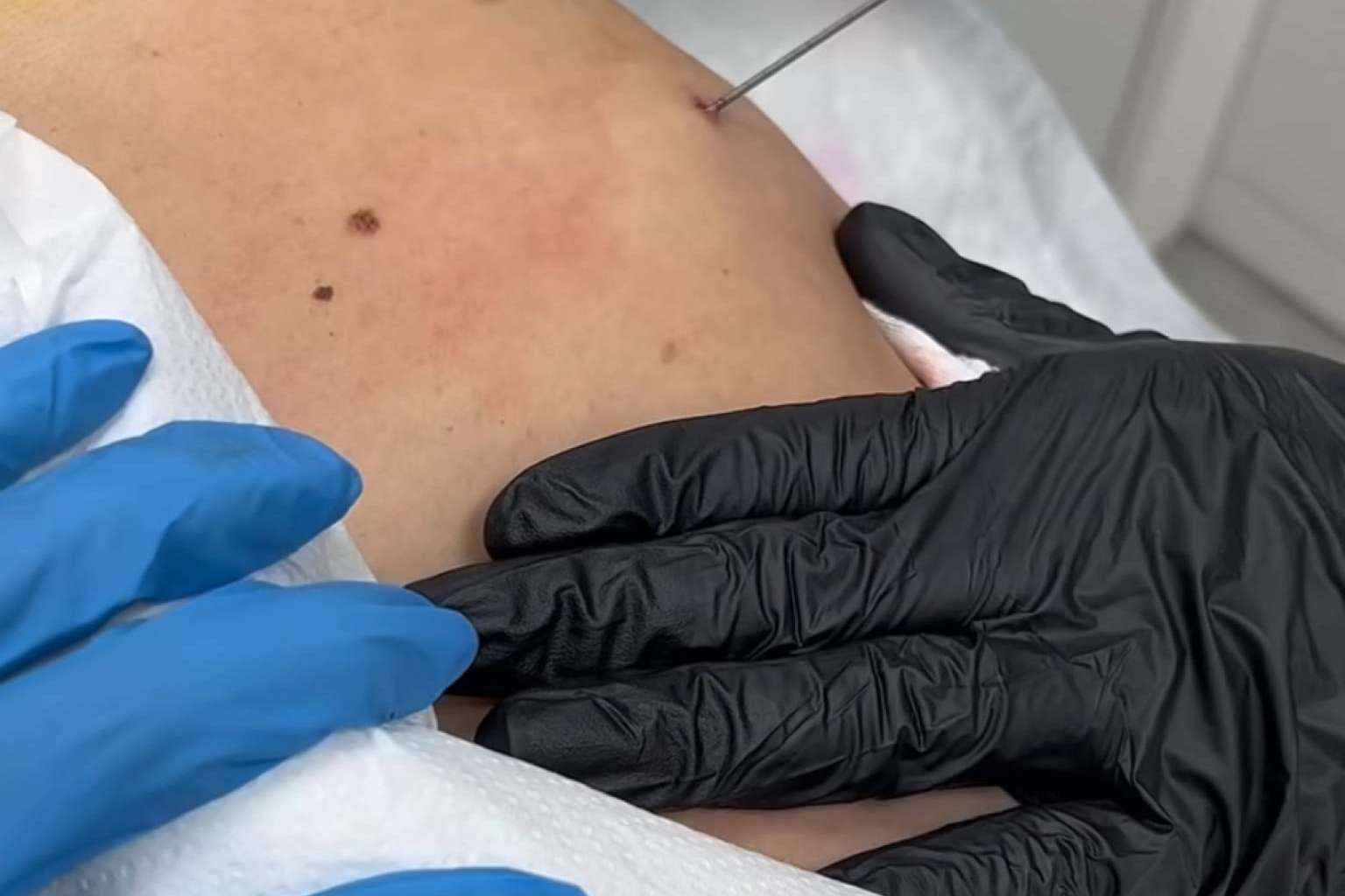 Capilar innovation en exclusiva con Endolif para reducción de grasa corporal y facial