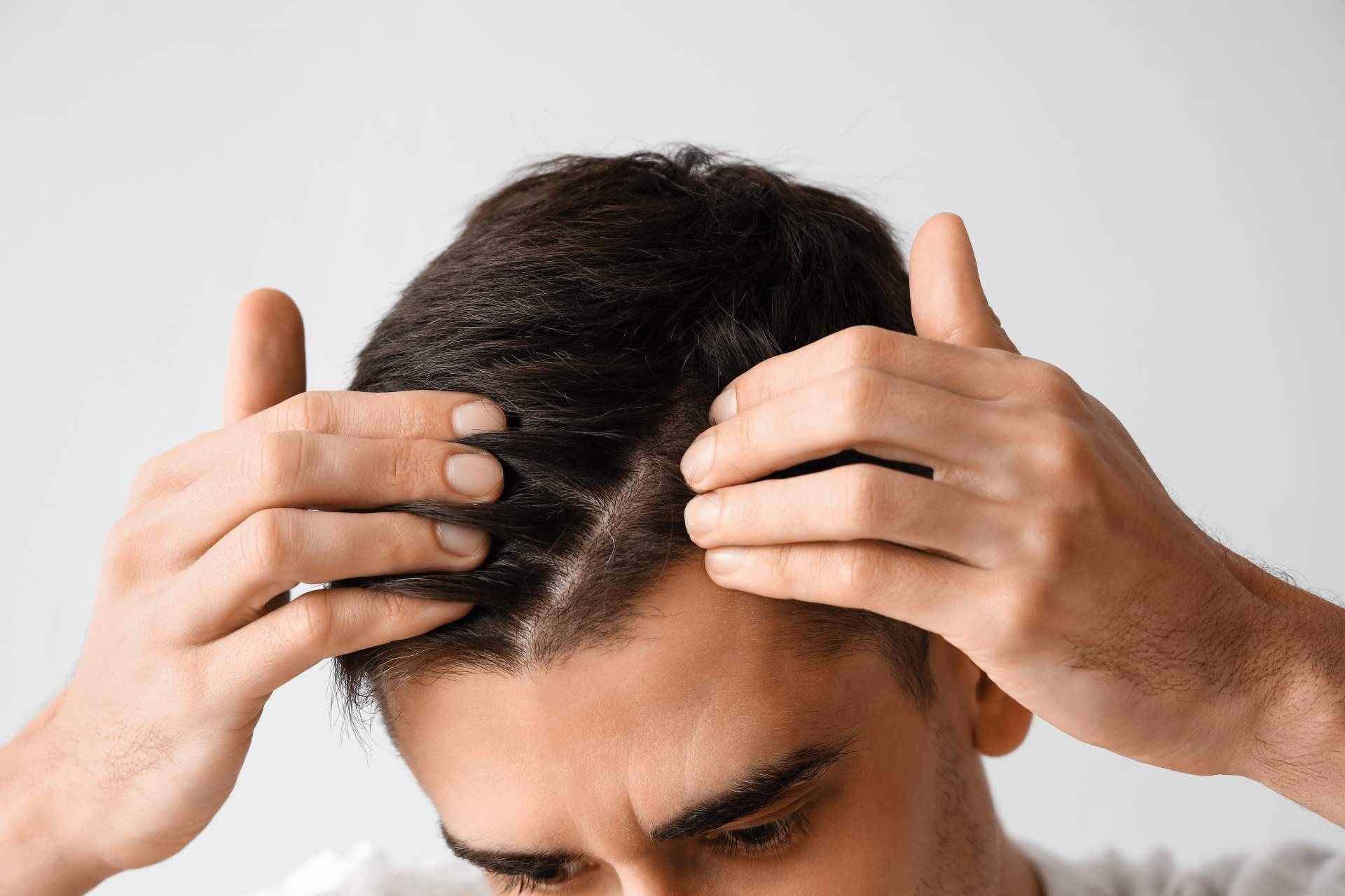 Un tratamiento para combatir la alopecia, así es Xpecia hombre