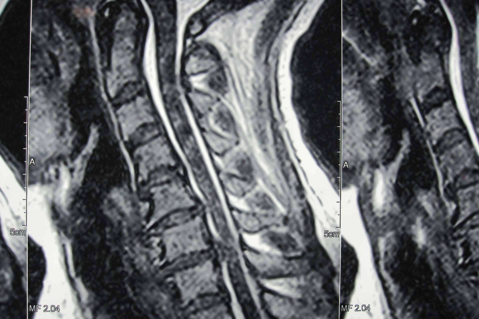 ¿En qué consiste la hernia disco cervical?, de la mano de Neurocirugía Galarza