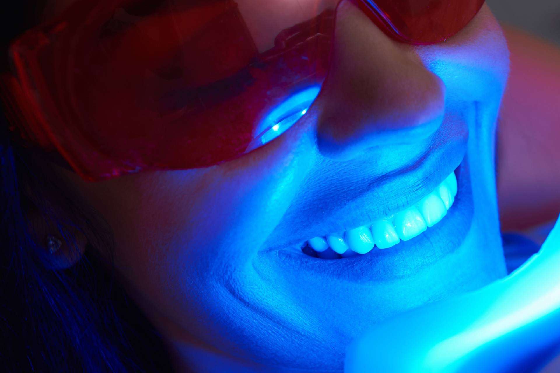 Blanqueamiento dental avanzado con luz LED para conseguir una apariencia radiante