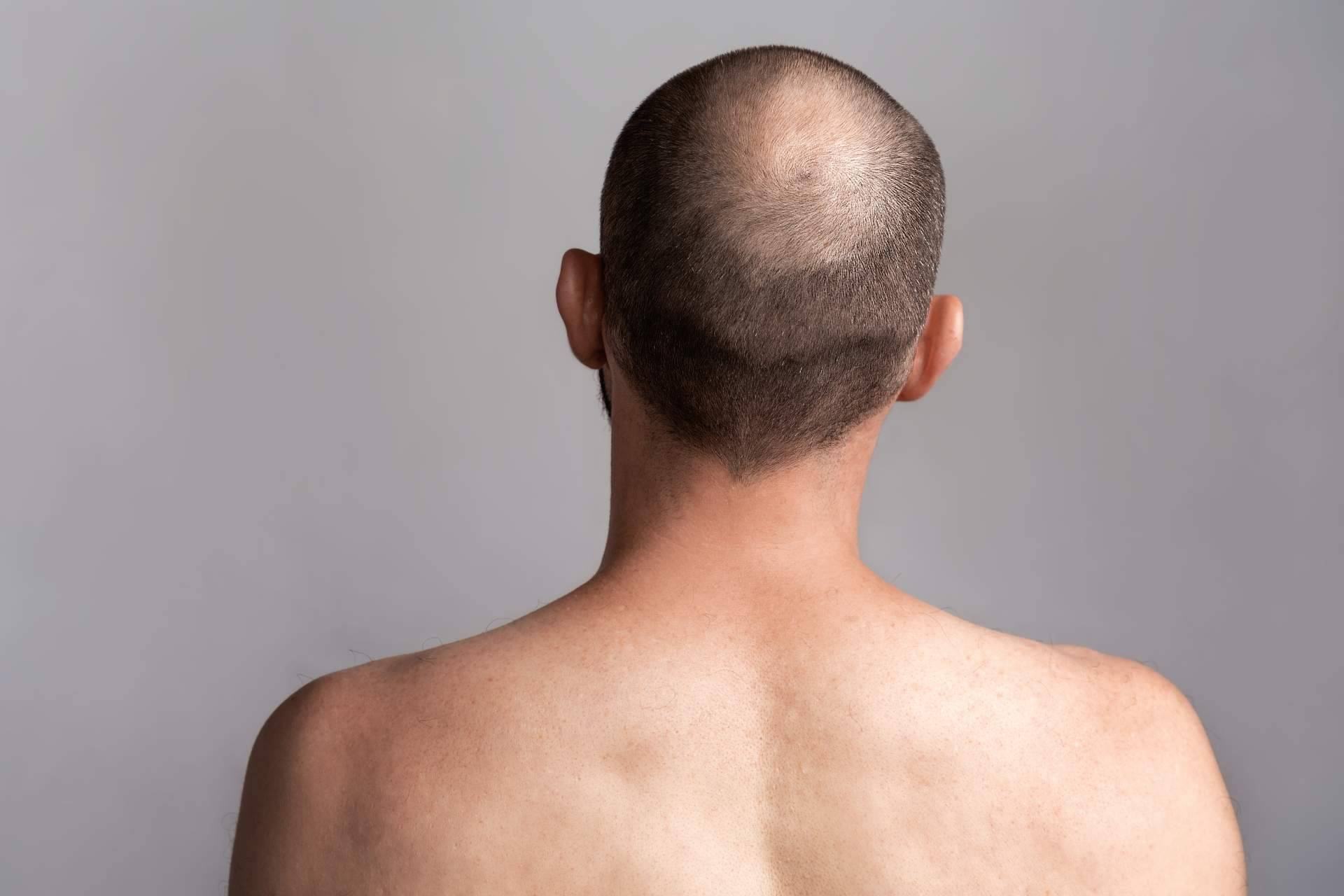 ¿Cuáles son los tratamientos para la alopecia androgénica de Saw Palmetto?