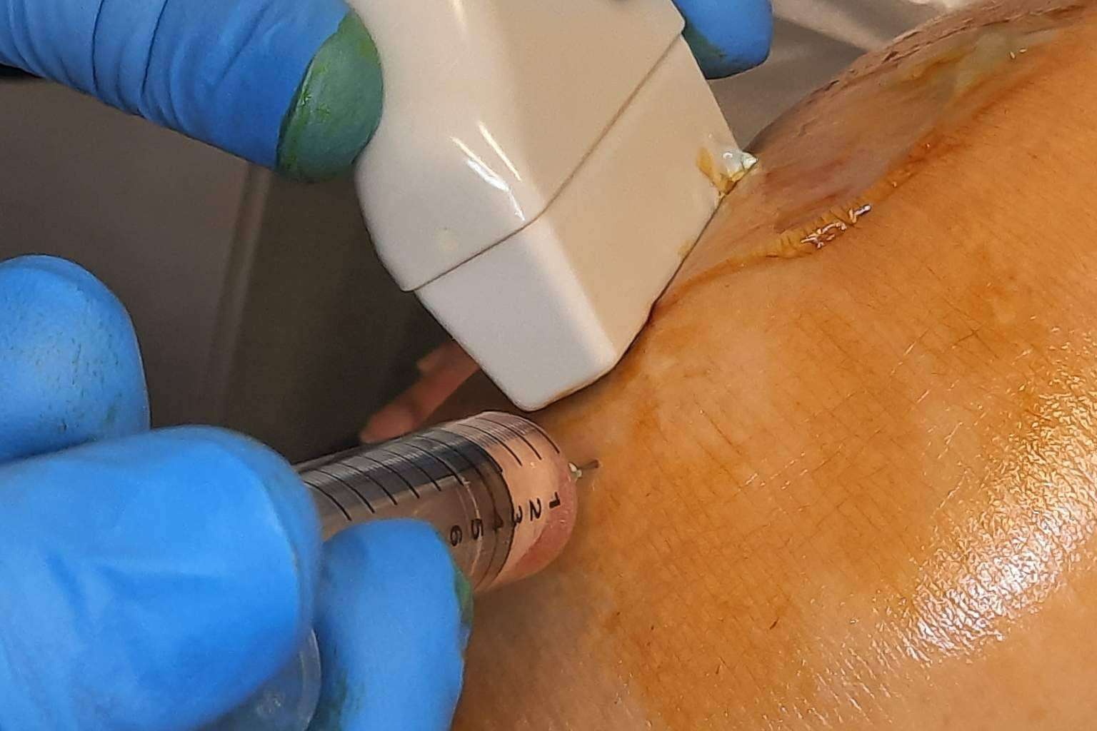 Infiltraciones de plasma rico en plaquetas y células madre, un tratamiento eficaz sin cirugía para artrosis de rodilla