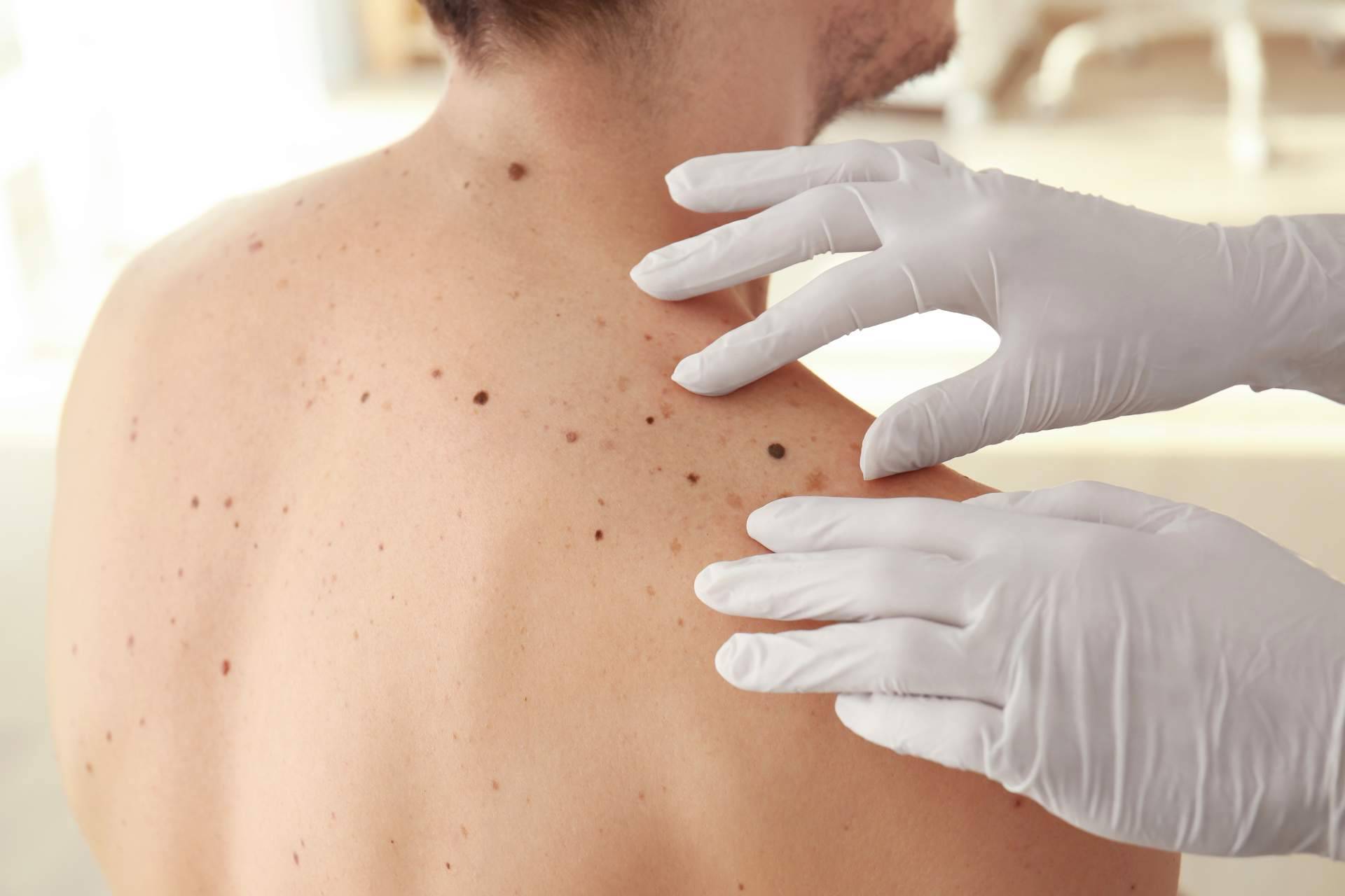 El Centro Estética el Pilar ofrece tratamientos para la eliminación de manchas en la piel en Madrid