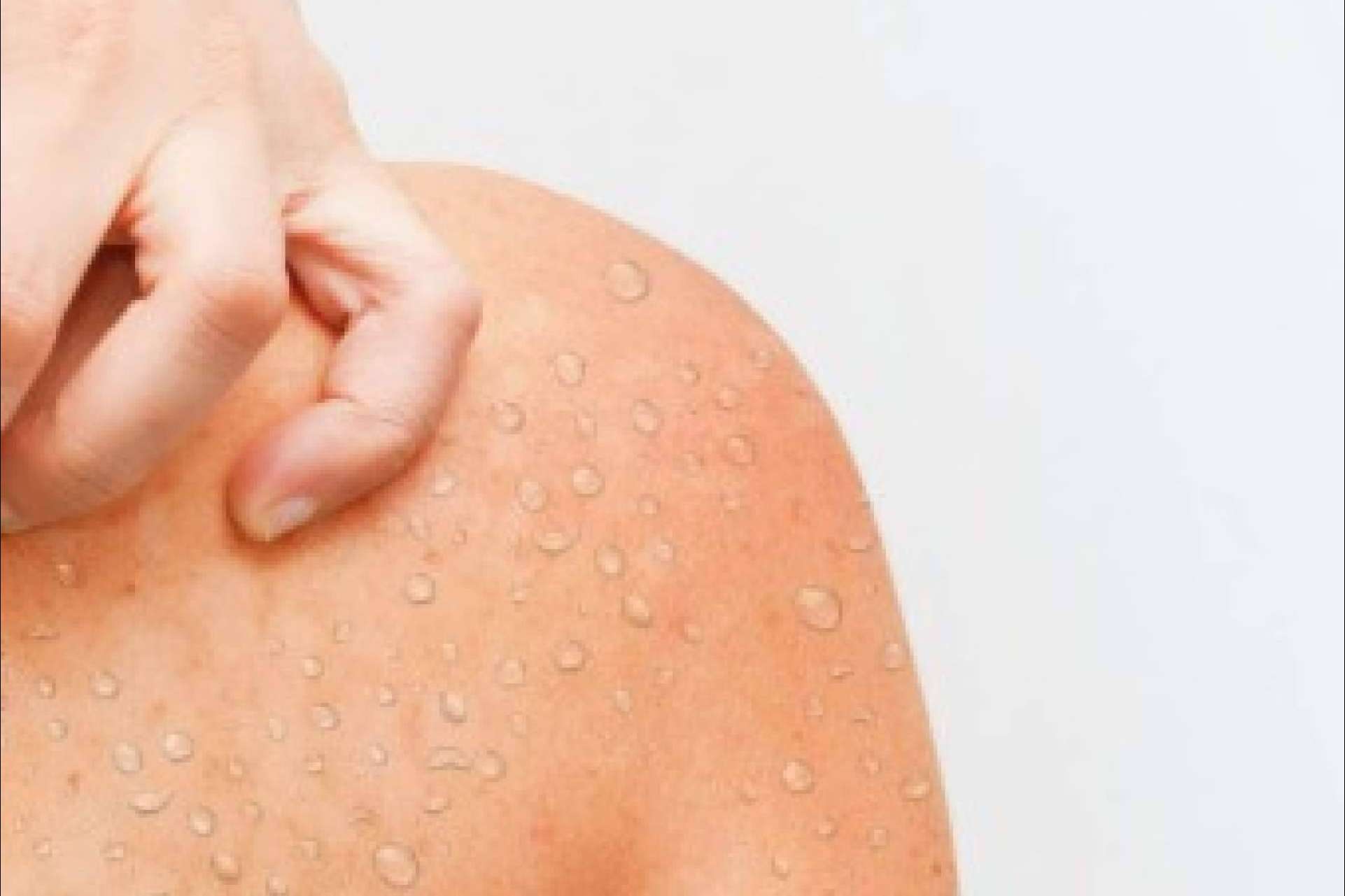 La micosis cutánea en verano; factores de riesgo y tratamientos eficaces
