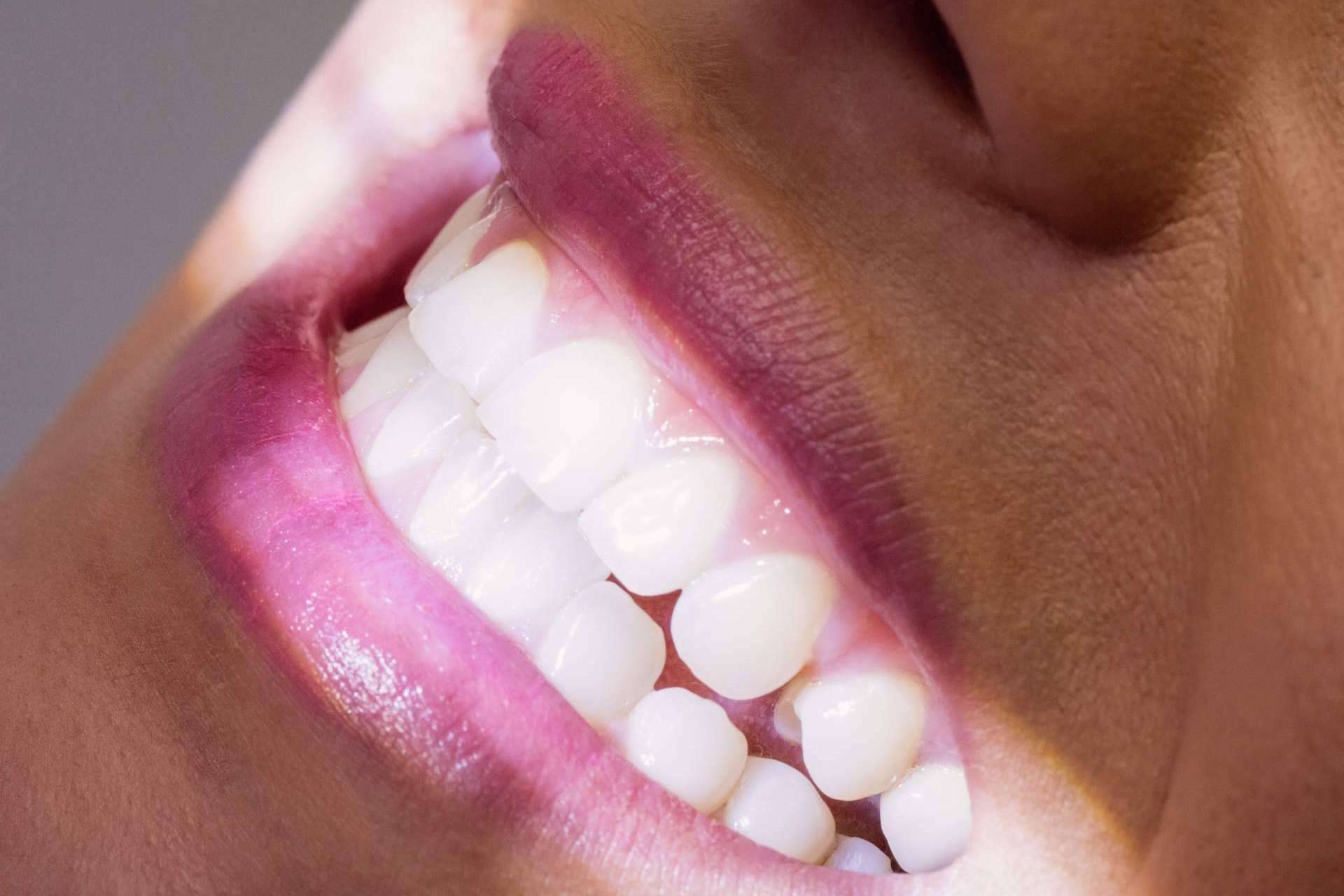 El blanqueamiento dental más exclusivo de Madrid, ahora al 50% en Clínica Calvo de Mora