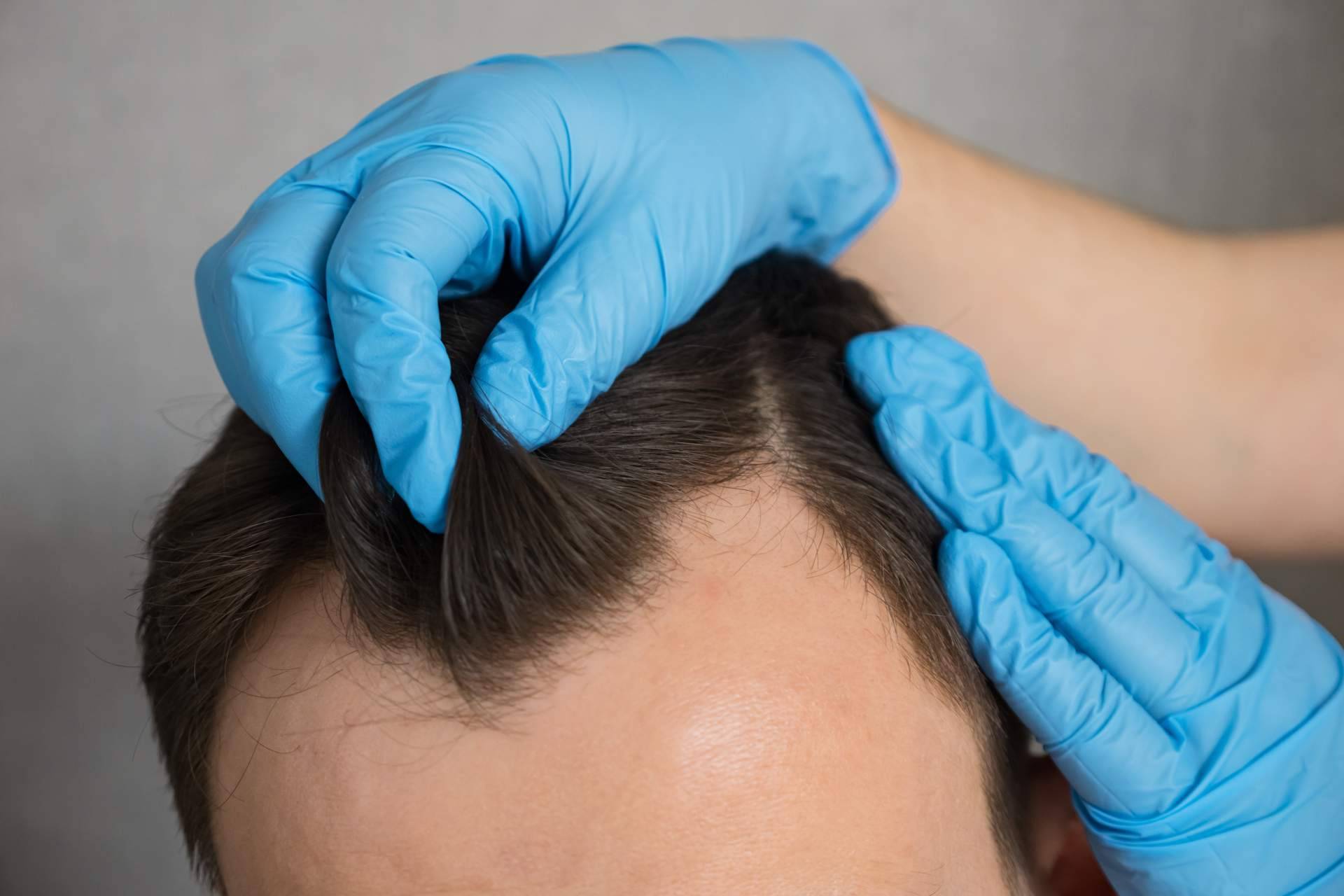 La mesoterapia capilar se abre paso como complemento al trasplante capilar en casos de pérdida de cabello