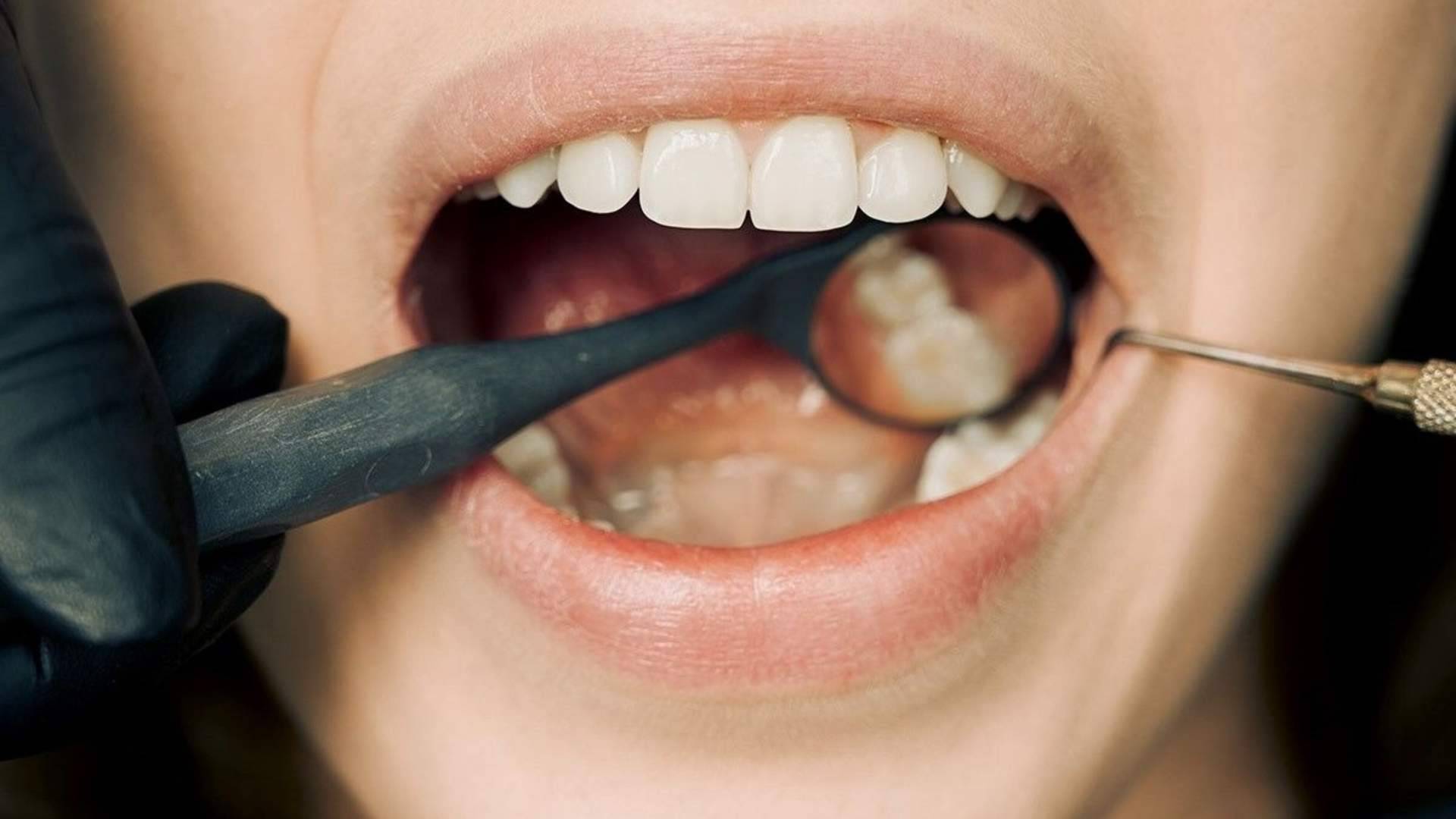 Carillas y prótesis fija de cerámica sin metal; soluciones estéticas orientadas a naturalidad y durabilidad